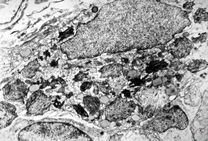 Whipple disease Whipple disease